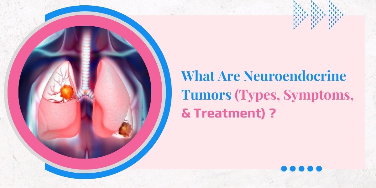 What Are Neuroendocrine Tumors (Types, Symptoms, And Treatment)?