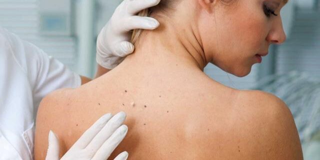 Skin Care : Spot The Warning Signs Of Skin Cancer